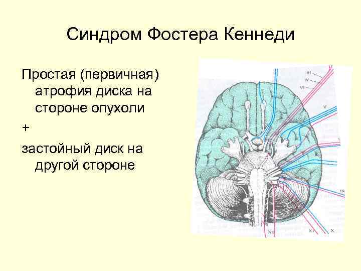  Синдром Фостера Кеннеди Простая (первичная)  атрофия диска на  стороне опухоли +