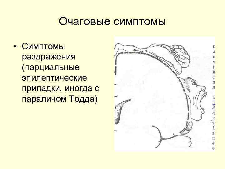    Очаговые симптомы  • Симптомы  раздражения  (парциальные  эпилептические