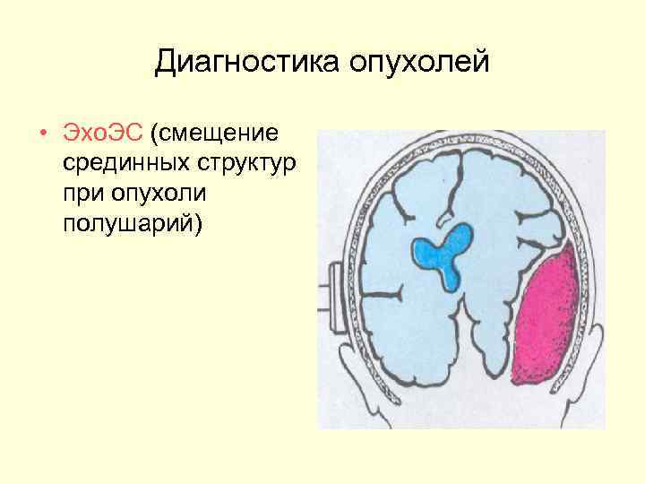   Диагностика опухолей  • Эхо. ЭС (смещение  срединных структур  при