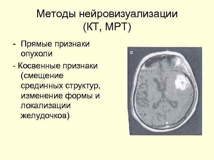  Методы нейровизуализации   (КТ, МРТ) - Прямые признаки  опухоли - Косвенные