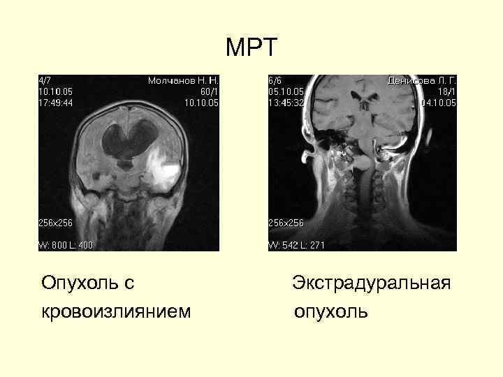 Мультинодулярная вакуолизирующая нейрональная опухоль мрт картинки