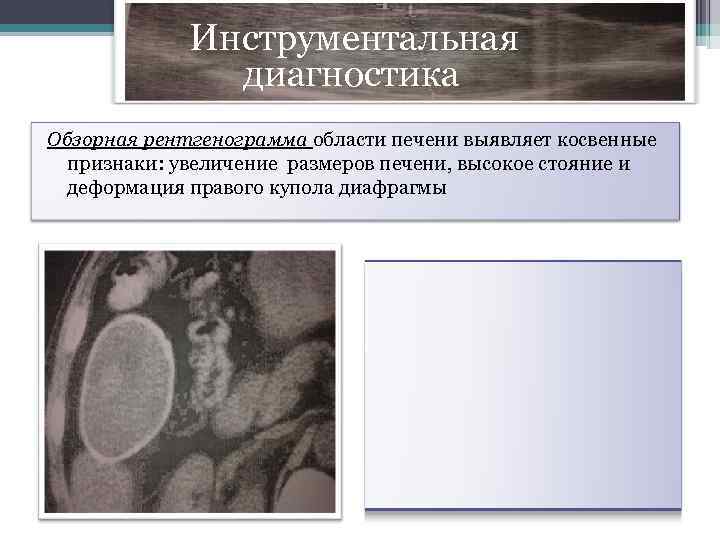  Инструментальная диагностика Обзорная рентгенограмма области печени выявляет косвенные признаки: увеличение размеров печени, высокое