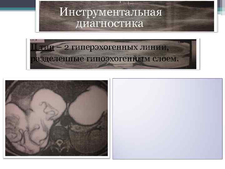  Инструментальная диагностика II тип – 2 гиперэхогенных линии, разделенные гипоэхогенным слоем. 