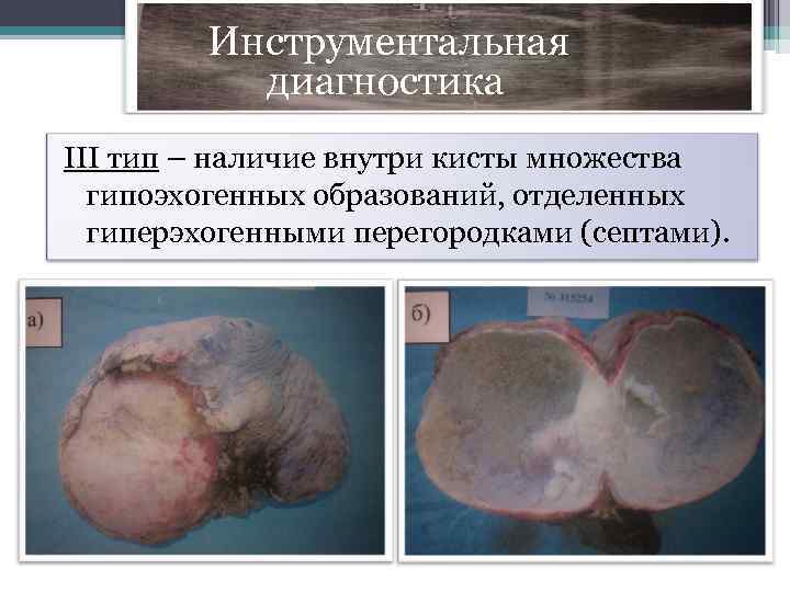  Инструментальная диагностика III тип – наличие внутри кисты множества гипоэхогенных образований, отделенных гиперэхогенными
