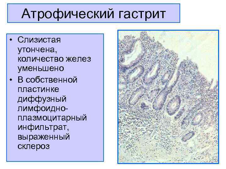  Атрофический гастрит • Слизистая  утончена,  количество желез  уменьшено • В