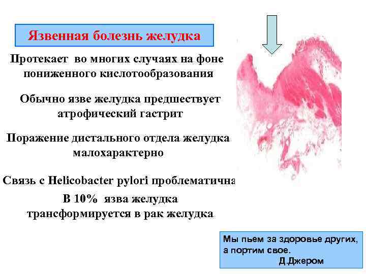   Язвенная болезнь желудка Протекает во многих случаях на фоне  пониженного кислотообразования