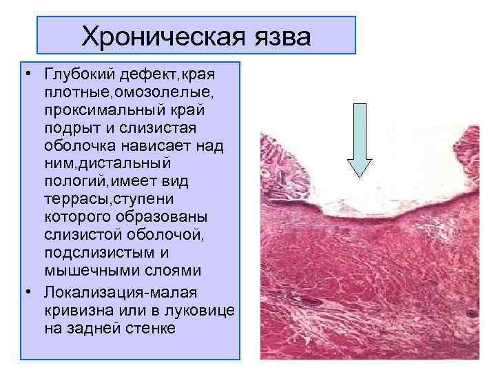  Хроническая язва • Глубокий дефект, края  плотные, омозолелые,  проксимальный край 