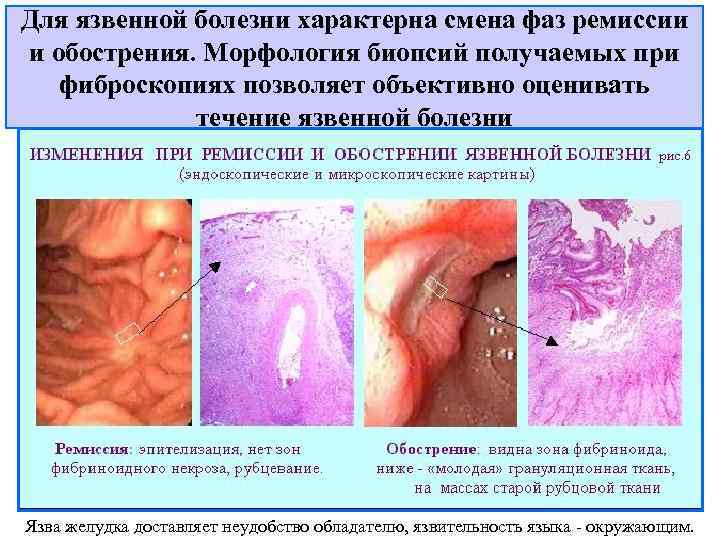 Для язвенной болезни характерна смена фаз ремиссии и обострения. Морфология биопсий получаемых при 