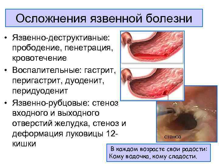 Положение фовлера при панкреатите картинка