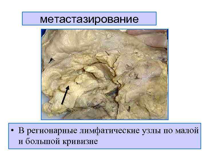  метастазирование • В регионарные лимфатические узлы по малой  и большой кривизне 