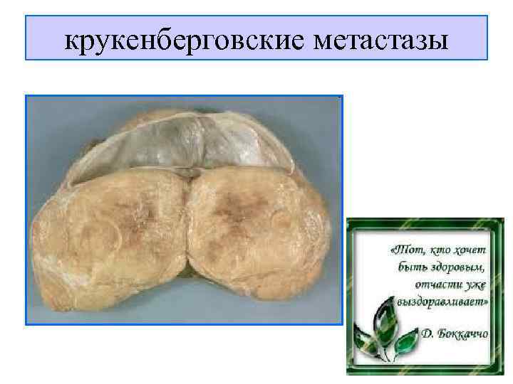 крукенберговские метастазы 