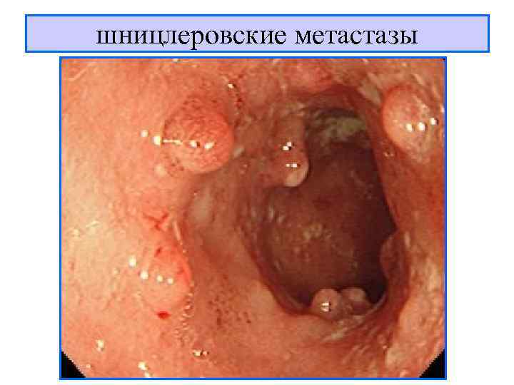 шницлеровские метастазы 