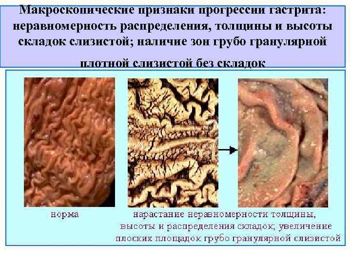  Макроскопические признаки прогрессии гастрита: неравномерность распределения, толщины и высоты складок слизистой; наличие зон