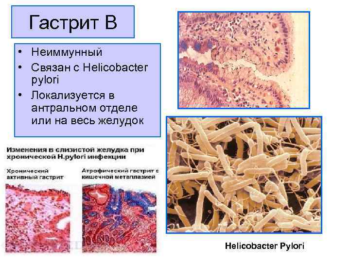 Гастрит В • Неиммунный • Связан с Helicobacter  pylori • Локализуется в