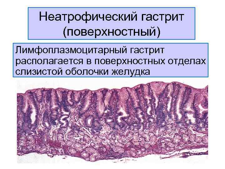 Лимфоплазмоцитарная инфильтрация желудка что это