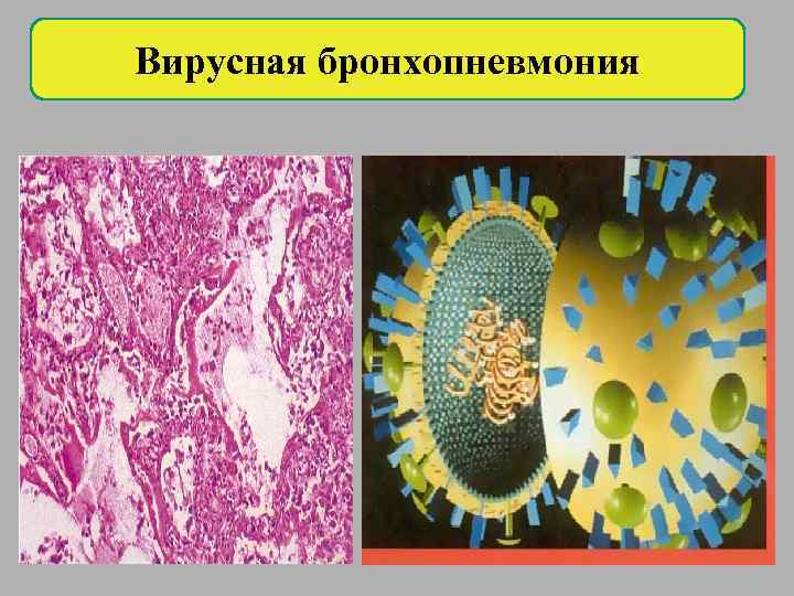 Вирусная бронхопневмония 