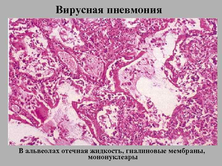    Вирусная пневмония В альвеолах отечная жидкость, гиалиновые мембраны,   