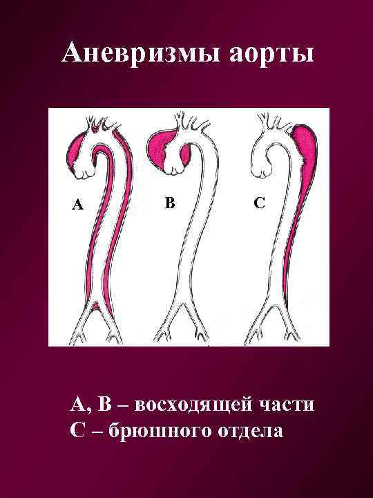 Аневризмы аорты А В С А, В – восходящей части С – брюшного отдела