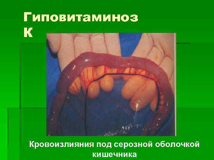 Гиповитаминоз К Кровоизлияния под серозной оболочкой   кишечника 