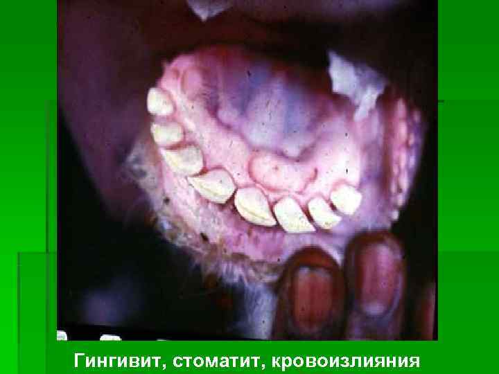 Гингивит, стоматит, кровоизлияния 