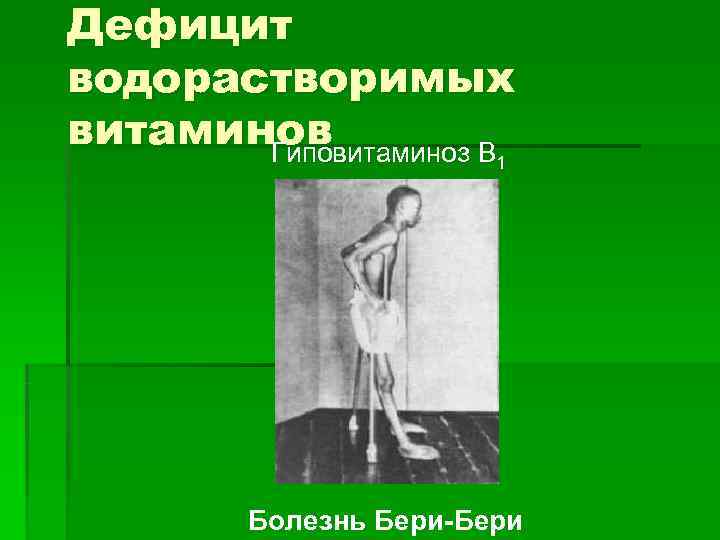 Дефицит водорастворимых витаминов  Гиповитаминоз В 1   Болезнь Бери-Бери 