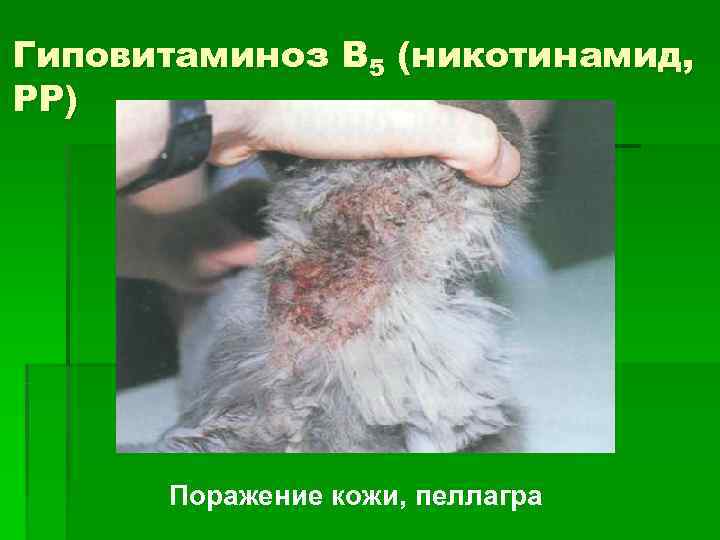Гиповитаминоз В 5 (никотинамид, РР)  Поражение кожи, пеллагра 