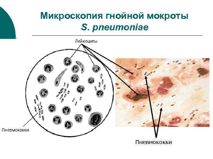 Образование мокроты. Мерцательный эпителий в мокроте микроскопия. Микроскопия мокроты при пневмонии. Микроскопия гнойной мокроты.