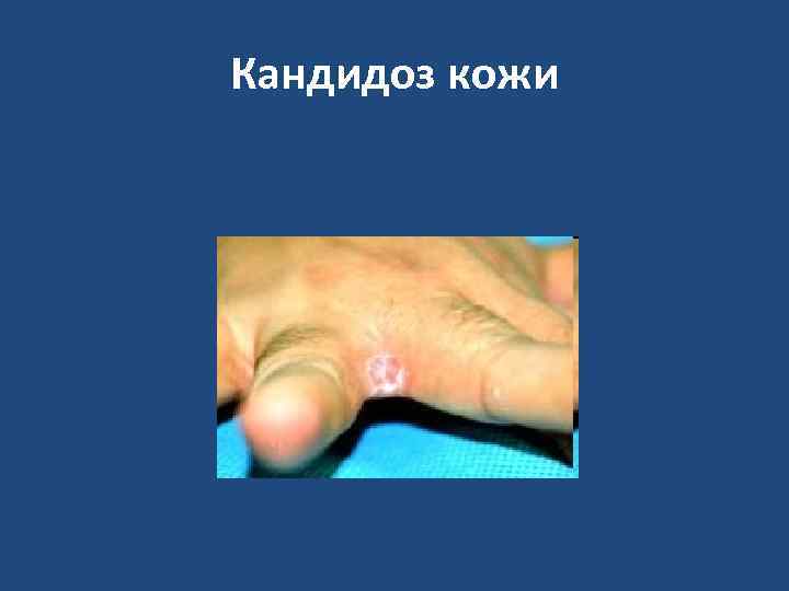Кандидоз кожи 