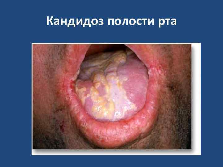 Кандидоз полости рта 