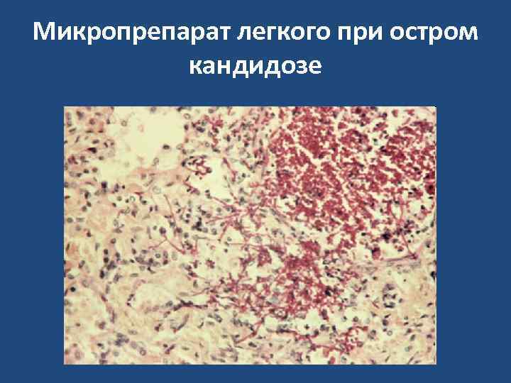 Микропрепарат легкого при остром  кандидозе 