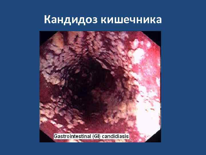 Кандидоз кишечника 