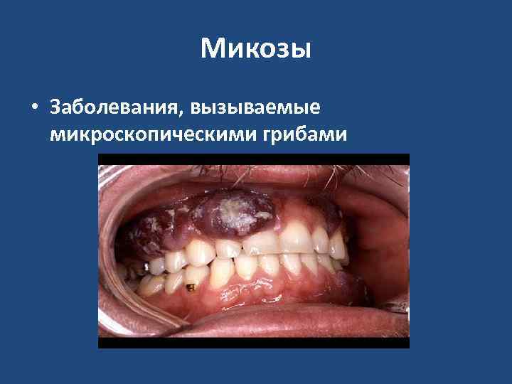    Микозы • Заболевания, вызываемые  микроскопическими грибами 