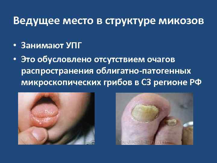 Ведущее место в структуре микозов • Занимают УПГ • Это обусловлено отсутствием очагов 