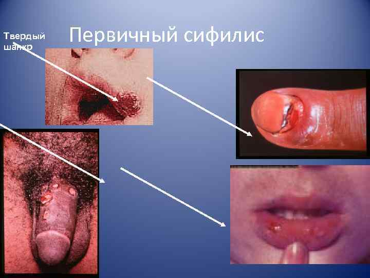 Твердый шанкр  Первичный сифилис 