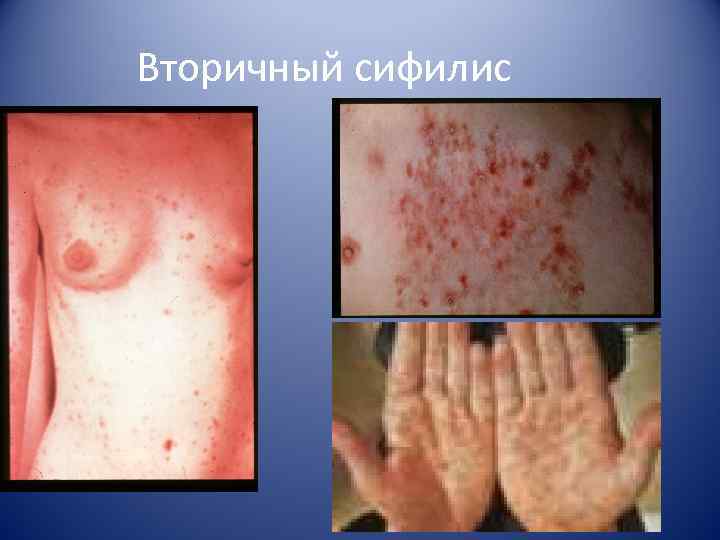Вторичный сифилис 