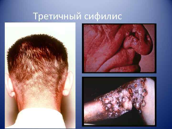 Третичный сифилис 