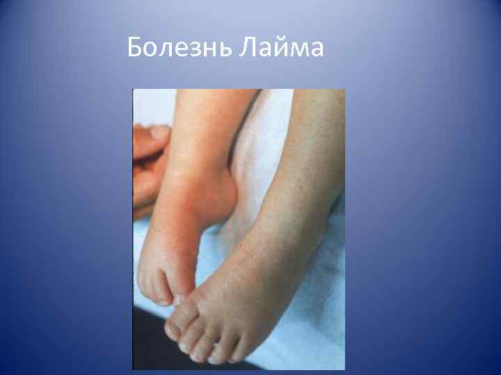 Болезнь Лайма 