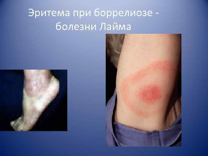 Эритема при боррелиозе - болезни Лайма 