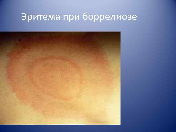Эритема при боррелиозе 