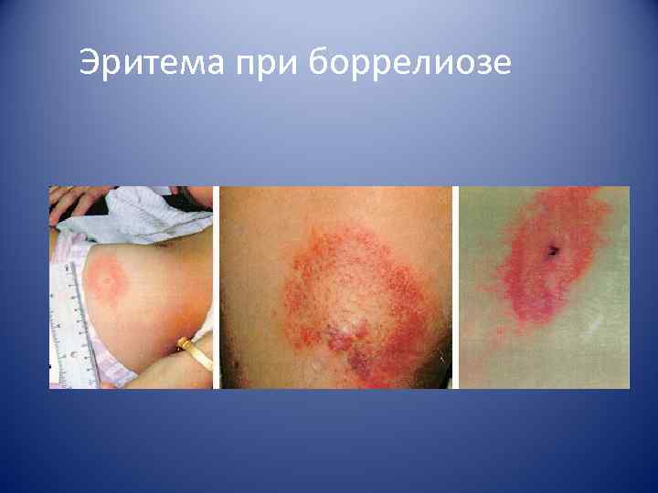 Эритема при боррелиозе 