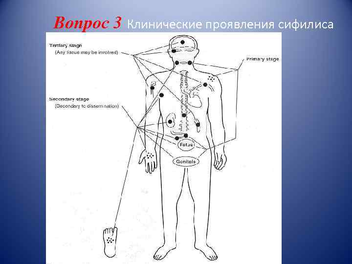 Вопрос 3 Клинические проявления сифилиса 