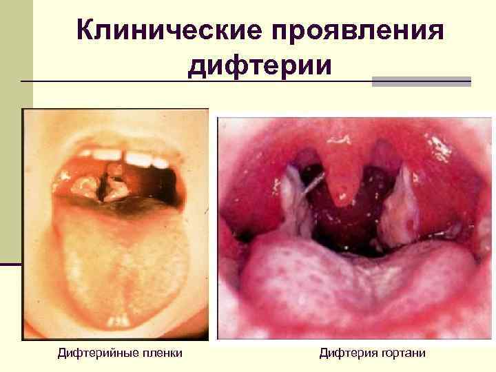  Клинические проявления   дифтерии Дифтерийные пленки  Дифтерия гортани 