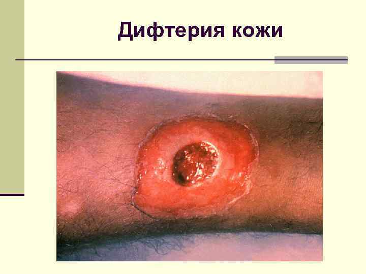 Дифтерия кожи 