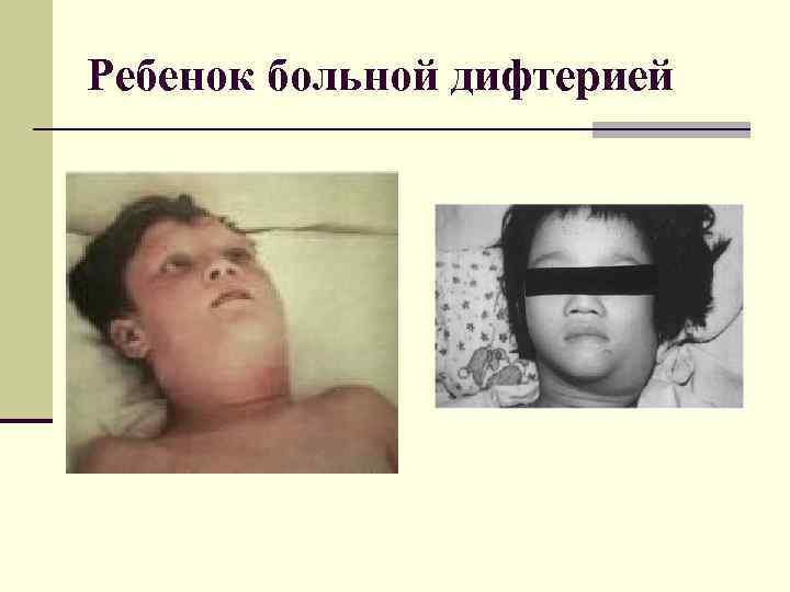 Ребенок больной дифтерией 
