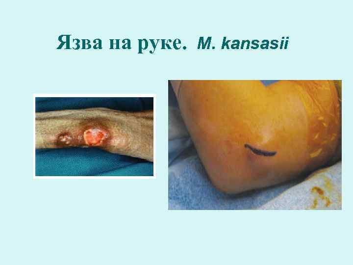 Язва на руке.  M. kansasii 