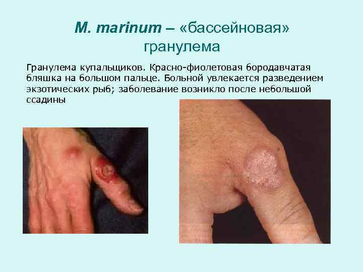    M. marinum – «бассейновая»    гранулема Гранулема купальщиков. Красно-фиолетовая