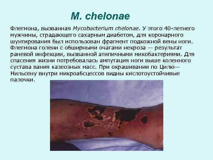     M. chelonae Флегмона, вызванная Mycobacterium chelonae. У этого 40 -летнего