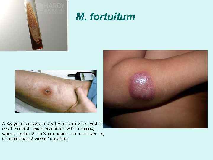        M. fortuitum A 35 -year-old veterinary technician