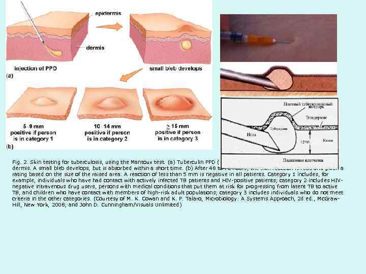 Fig. 2 Skin testing for tuberculosis, using the Mantoux test. (a) Tuberculin PPD (purified