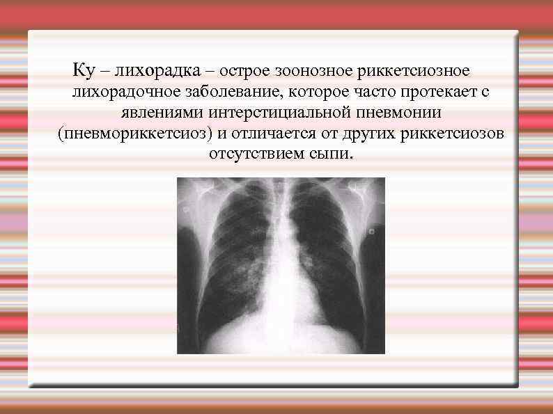  Ку – лихорадка – острое зоонозное риккетсиозное  лихорадочное заболевание, которое часто протекает